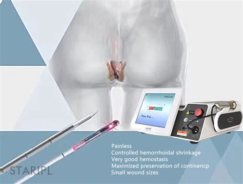 Invasive Laser For Fistula Pilonidal Treatment Hemorrhoids Removal