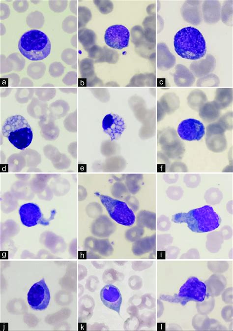 A F Atypical Lymphoid Cells Of Class A With Immunoglobulin Crystals