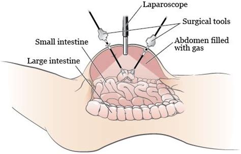 Figure 1 Your Abdomen During A Diagnostic Laparoscopy Laparoscopic