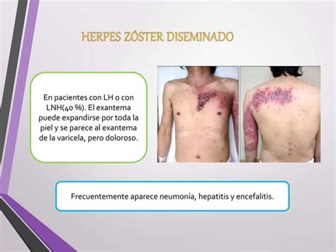 Herpes Zoster Y Sindrome De Ramsay Hunt Ppt