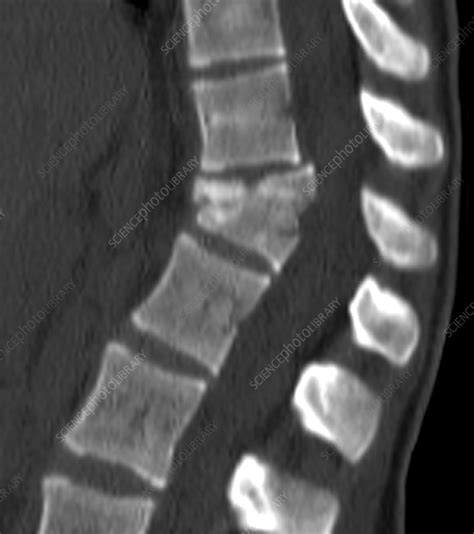 Thoracic Spine Fracture Ct Scan Stock Image C Science