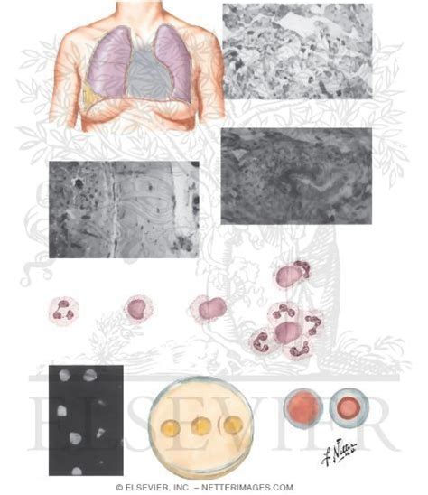 Systemic Lupus Erythematosus Sle Lung Involvement