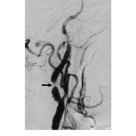 Right Common Carotid Angiogram Showing The Stenosis In The Internal Download Scientific Diagram