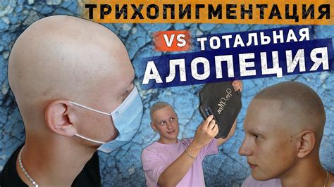 Трихопигментация vs Тотальная алопеция. Scalp micropigmentation by ...