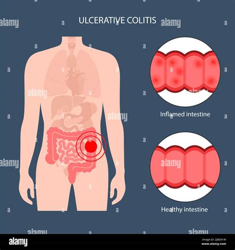 Ulcerative Colitis Illustration Stock Photo Alamy