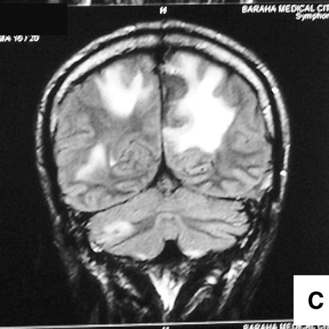 Symptoms and signs in 16 patients with intracranial tuberculoma | Download Table