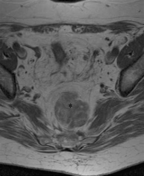 Figure From Presacral Myelolipoma In A Patient With Rectal Cancer