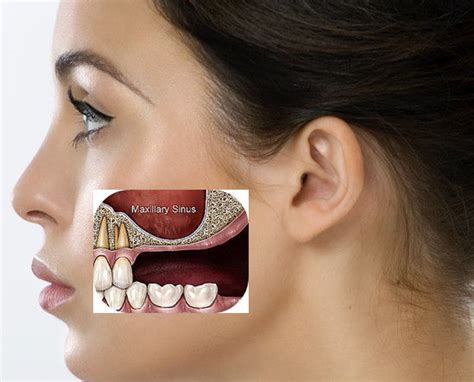 Oral Antral Fistulas