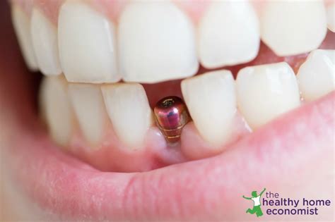 How to Get Dental Implants without Destroying Your Health - Healthy ...
