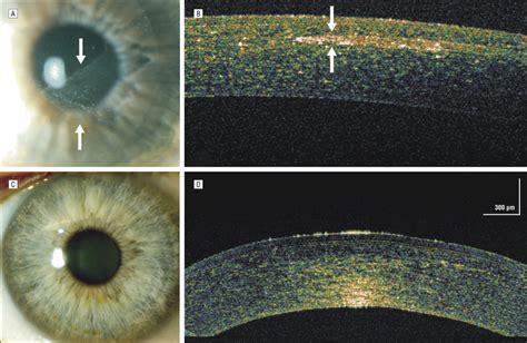 Complicated Laser In Situ Keratomileusis Lasik A Trauma To The