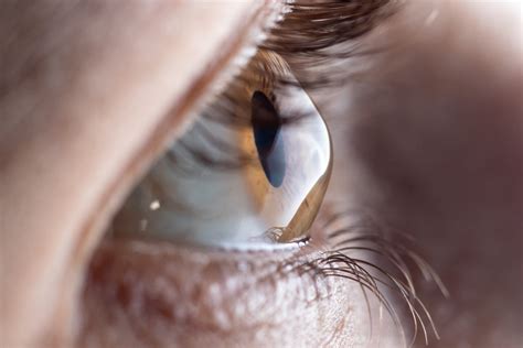 Corneal Ulcer Symptoms Causes And Treatments Tower Clock Eye Center