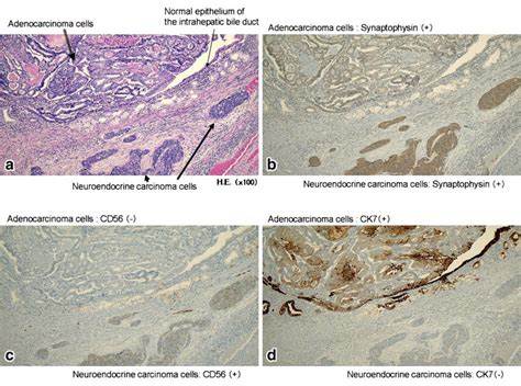 Histologically, neuroendocrine carcinoma component was coexistent with... | Download Scientific ...