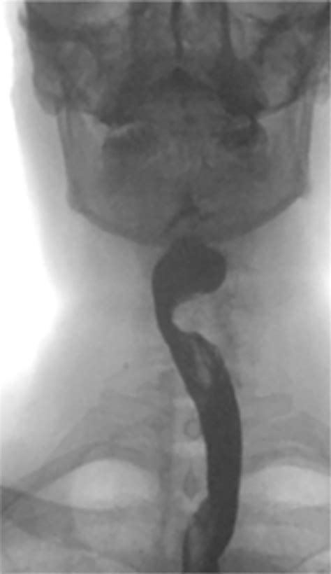 Figure 2 From The Surgical Management Of Dysphagia Secondary To Diffuse Idiopathic Skeletal