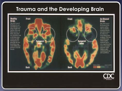 PPT - The ( Neuro )Biological Impact of Trauma on the Brain PowerPoint ...