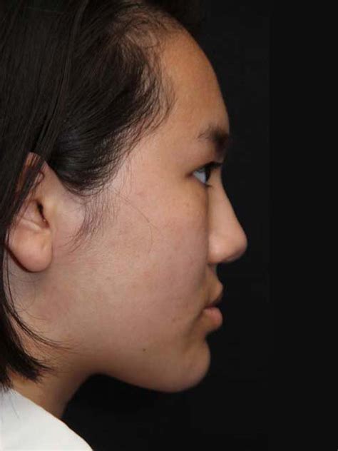 Patient Revision Rhinoplasty Solomon Facial Plastic