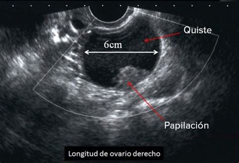 Ovarios poliquísticos TODO lo que DEBES Saber Medicina Salud Mujer