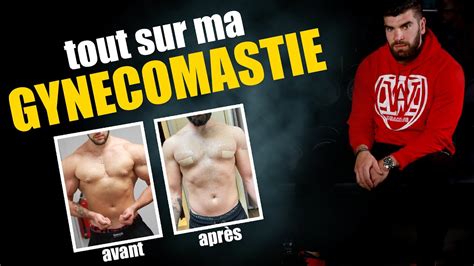 Tout Sur La Gyn Comastie Mon Avant Apr S Youtube