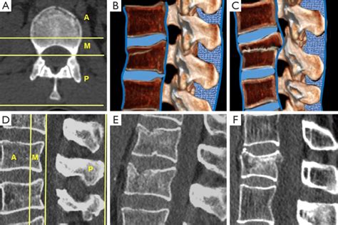 Three Columns Denis Model A Axial Scheme B Sagittal Scheme Of