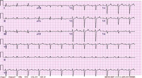 Non Specific Interventricular Conduction Delay NSIVCD ECG Example 2