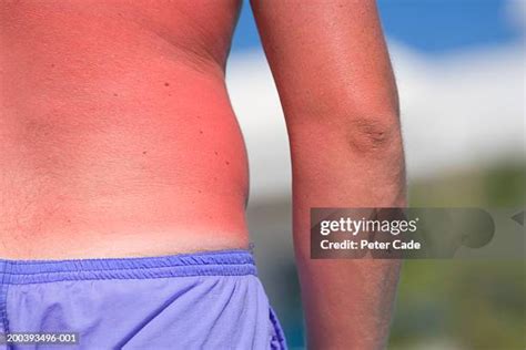 Sunburn Man Back Stock Fotos Und Bilder Getty Images