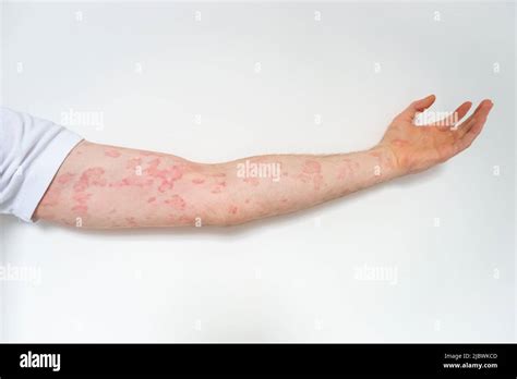 Photograph Showing A Mans Arm With Chronic Urticaria Or Hives A Rash With Red Bumpy Welts That