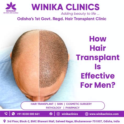 Pin On Hair Transplant