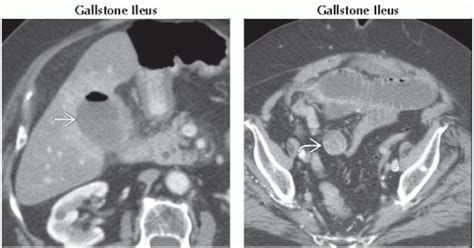 Da Db Small Bowel Obstruction Ffu Abdominal Key