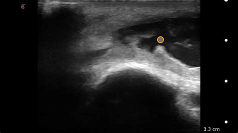 Image Interpretation Olecranon Bursitis Youtube