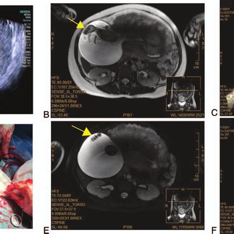 Ultrasound Magnetic Resonance Imaging And Surgical Image Of The