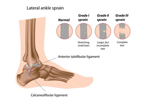 Ankle Sprain Treatment Exercises