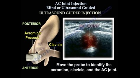 Ac Joint Ultrasound