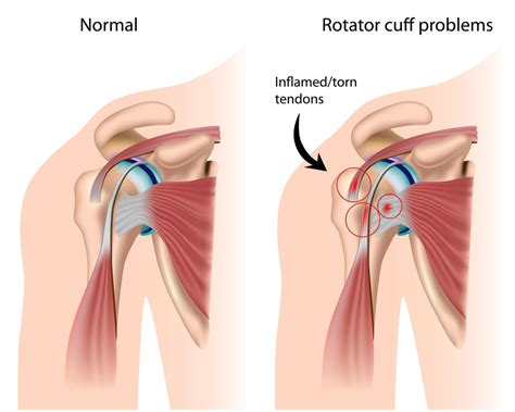 Arthroscopic Rotator Cuff Repair Dr Kalman Piper