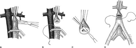 Aortofemoral Bypass Basicmedical Key