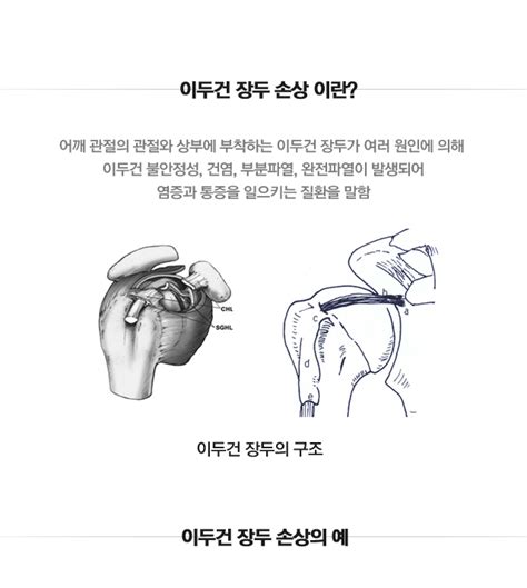 마디사랑병원 질환별 소개 어깨 이두건 장두 손상