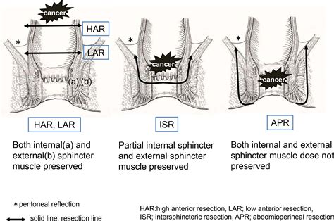 Low Anterior Resection