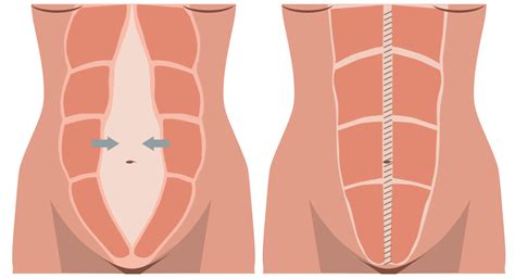 Di Stase Abdominal O Que E Como Corrigir Dr Rafael Zatz