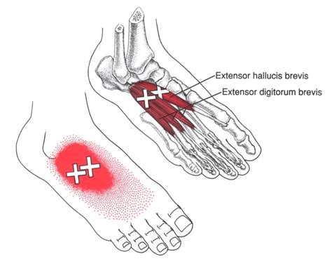 Extensor Hallucis Brevis The Trigger Point And Referred Pain Guide