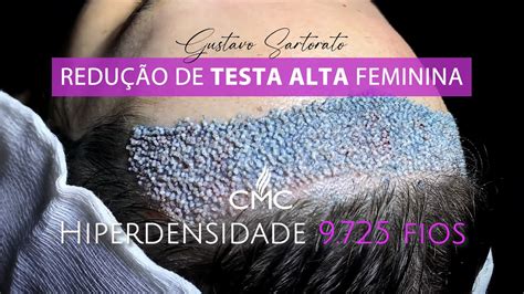 Redução de TESTA ALTA feminina YouTube