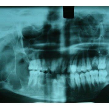 Orthopantomograph Showing Multiple Multilocular Well Defined