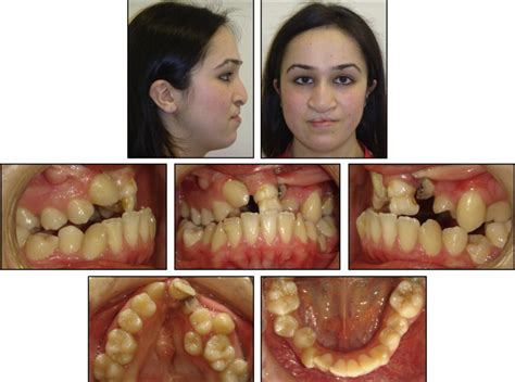 Interdisciplinary Treatment Of A Patient With Bilateral Cleft Lip And Palate And Congenitally