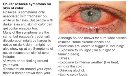 Ocular Rosacea Introduction Symptoms And Causes Diagnosis