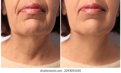 Mature Woman Before After Skin Tightening Stock Photo