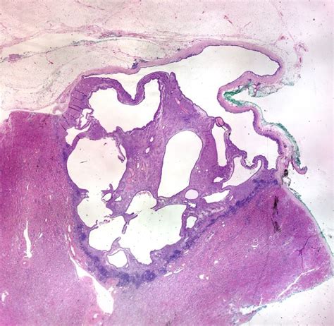 Mixed Epithelial And Stromal Tumor Mest Pathology Image