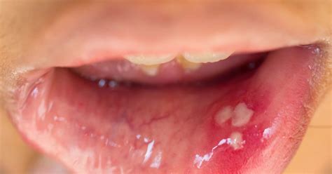 Hpv In The Mouth Symptoms Causes And Treatment