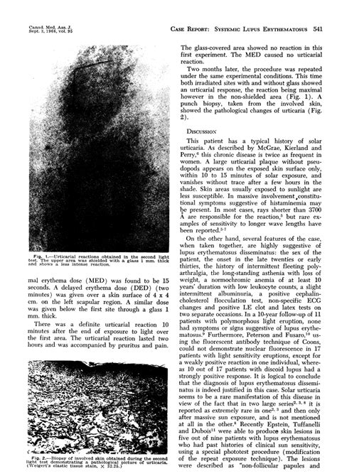 Solar Urticaria As The Presenting Manifestation Of Systemic Lupus