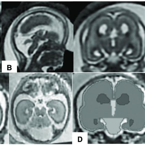 Post Acquisition Processing For Volumetric Analysis Of Fetal Mri Raw