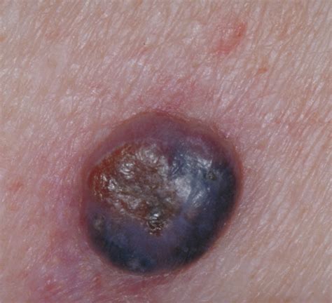 List Pictures Photos Of Melanoma In Situ Latest