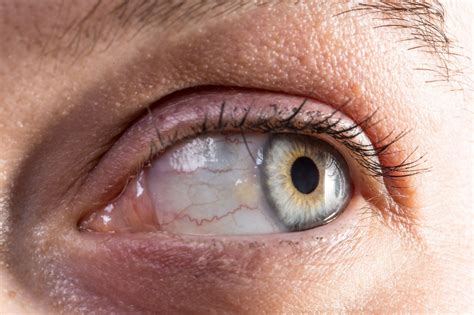Ophthalmology 360 A New Era In Dry Eye Therapy The Semifluorinated