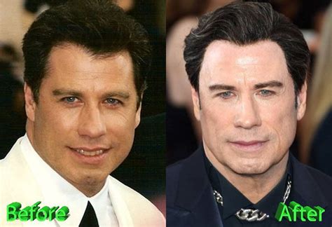 John Travolta Before And After Plastic Surgery Celebrity Plastic