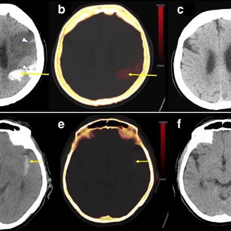 Pdf Bjr Pictorial Review Dual Energy Ct A Step Ahead In Brain And